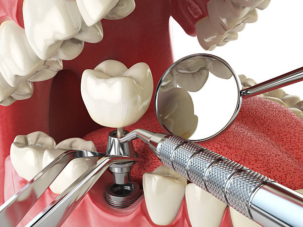 Best Emergency Root Canal Treatment in Locust, NC